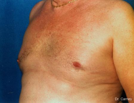 Virginia Beach Gynecomastia 1227 - After Image 1