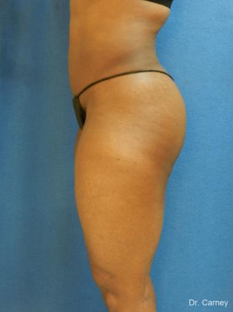 Brazilian Butt Lift: Patient 3 - After Image 2
