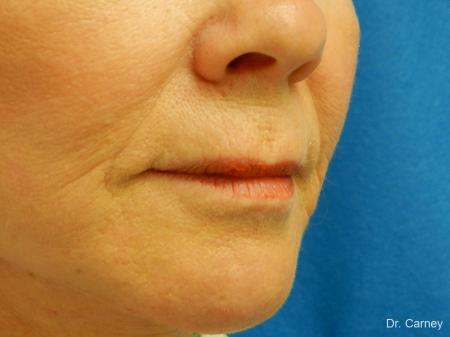 Virginia Beach Laser Skin Resurfacing Face 1263 - After Image 3