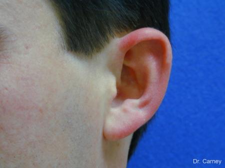 Virginia Beach Otoplasty Earlobe Repair 1237 - Before Image 3
