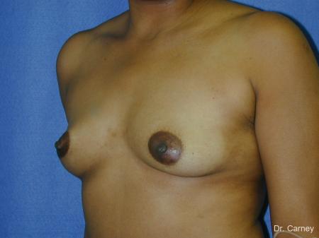 Virginia Beach Breast Augmentation 1091 - Before and After Image 3