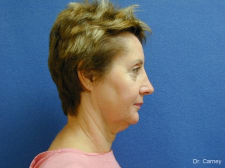 Virginia Beach Brow Lift 1216 - Before and After Image 5