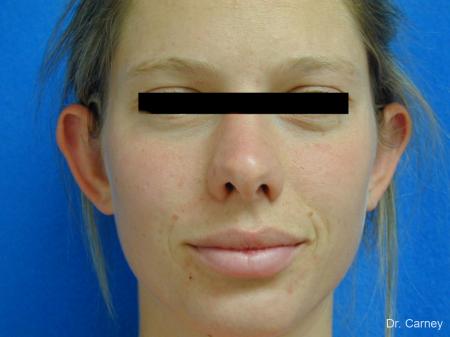 Virginia Beach Otoplasty Earlobe Repair 1223 - Before Image 3