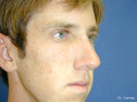 Virginia Beach Rhinoplasty 1219 - After Image 3