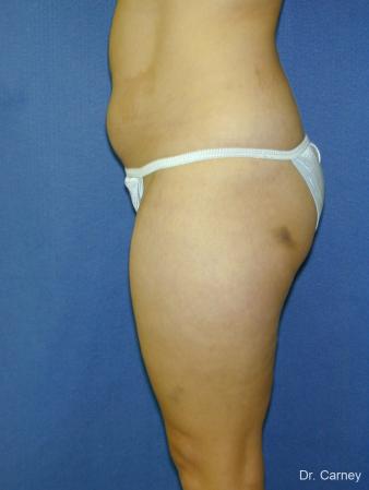 Virginia Beach Liposuction 1284 - Before Image 3