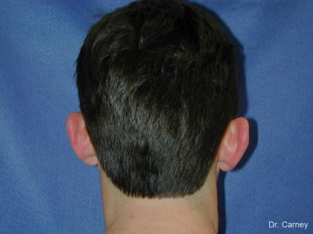 Virginia Beach Otoplasty Earlobe Repair 1237 - Before Image 1
