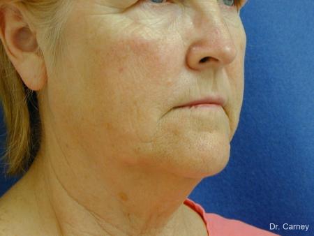 Virginia Beach Neck Lift 1207 - Before Image 1