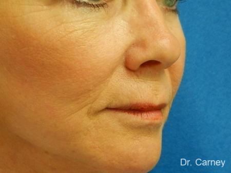 Virginia Beach Laser Skin Resurfacing - Face 1260 - After Image 1