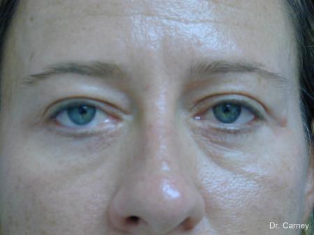 Virginia Beach Eyelid Lift 1209 - After Image 1