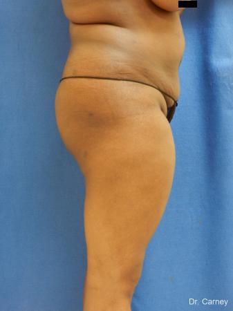 Brazilian Butt Lift: Patient 5 - After Image 5