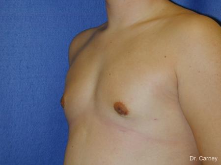Virginia Beach Gynecomastia - After Image 3