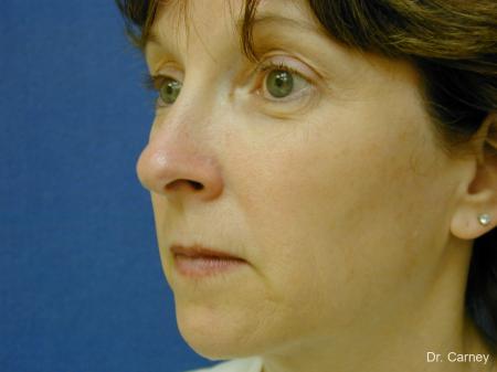 Virginia Beach Brow Lift 1217 - Before and After Image 4