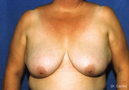 Virginia Beach Breast Lift 1186 - Before Image 1