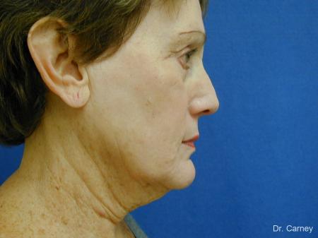 Virginia Beach Facelift 1133 - Before Image 1