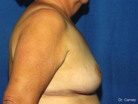 Virginia Beach Breast Reduction 1234 - After Image 2