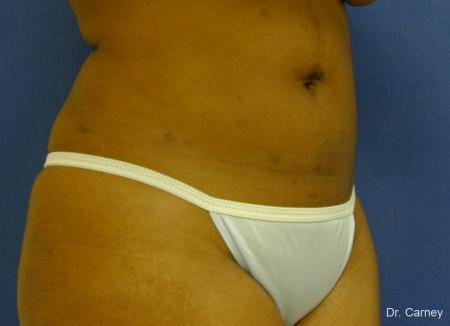 Virginia Beach Liposuction 1283 - After Image 4