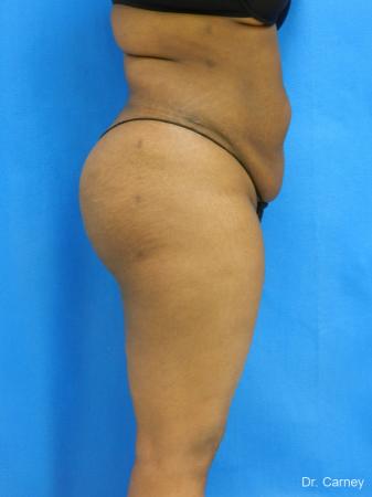 Brazilian Butt Lift: Patient 4 - After Image 5
