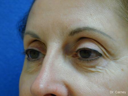 Virginia Beach Eyelid Lift 1131 - Before and After Image 3