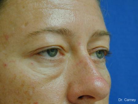 Virginia Beach Eyelid Lift 1209 - Before Image 2