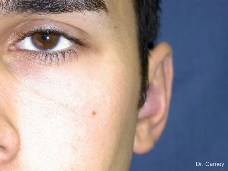 Virginia Beach Otoplasty Earlobe Repair 1222 - After Image 4
