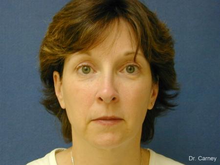 Virginia Beach Brow Lift 1217 - Before Image 1