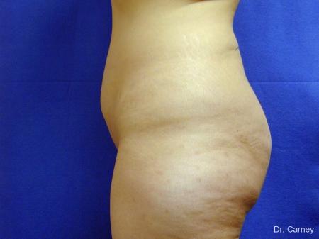 Tummy Tuck: Patient 1 - Before and After Image 4
