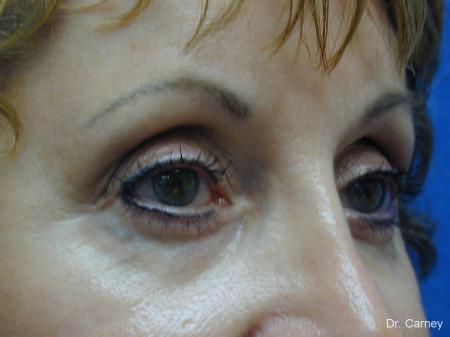 Virginia Beach Brow Lift 1216 - After Image 2