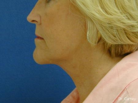 Virginia Beach Neck Lift 1207 - After Image 3