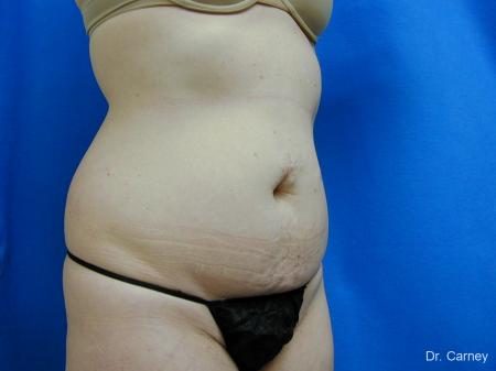 Virginia Beach Tummy Tuck 1251 - Before Image 2