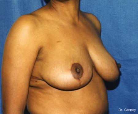 Virginia Beach Breast Reduction 1228. - After Image 2