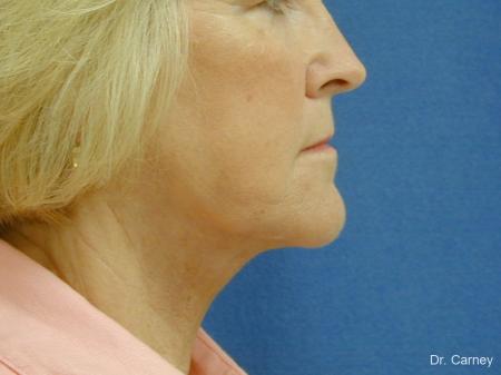 Virginia Beach Neck Lift 1207 - After Image 2