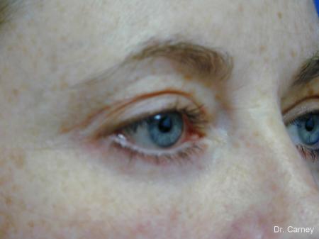 Virginia Beach Eyelid Lift 1138 - After Image 2