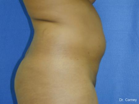 Virginia Beach Liposuction 1283 - Before Image 2