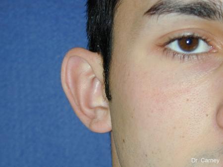 Virginia Beach Otoplasty Earlobe Repair 1222 - Before Image 1