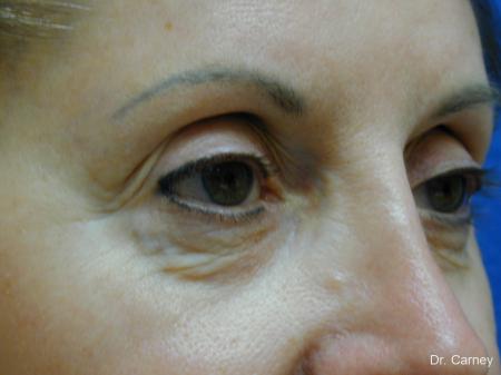 Virginia Beach Brow Lift 1216 - Before Image 2
