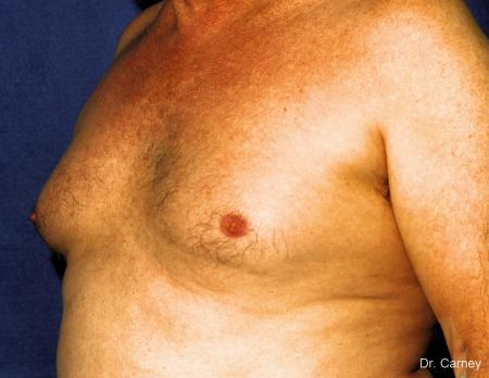 Virginia Beach Gynecomastia 1227 - Before Image 1