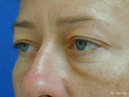 Virginia Beach Eyelid Lift 1209 - Before and After Image 3