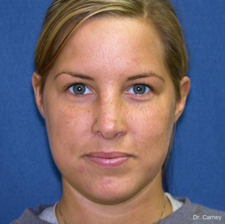 Virginia Beach Rhinoplasty 1218 - After Image 5
