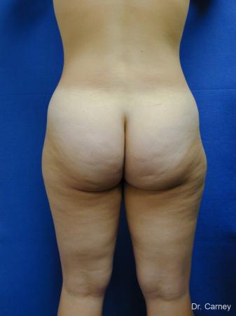 Virginia Beach Liposuction 1276 - Before Image 3