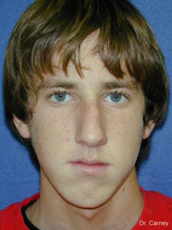 Virginia Beach Rhinoplasty 1219 - Before Image 2