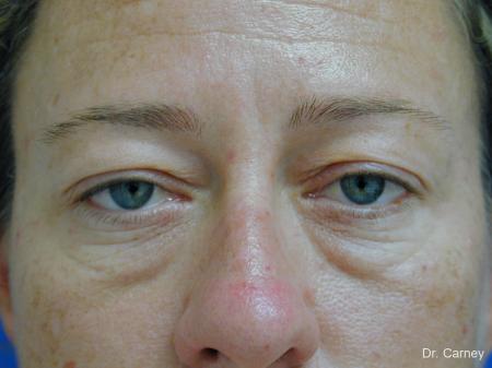 Virginia Beach Eyelid Lift 1209 - Before Image 1
