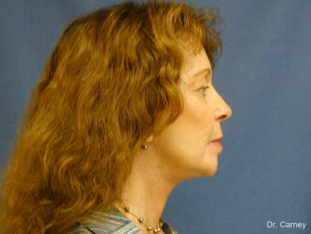 Virginia Beach Facelift 1127 - After Image 2
