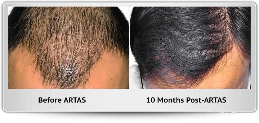 Hair Transplantation: Patient 5 - Before and After Image 1