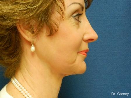 Virginia Beach Facelift 1132 - After Image 3