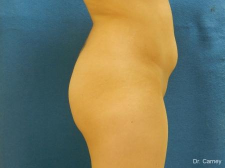 Virginia Beach Brazilian Butt Lift 1221 - Before Image 1