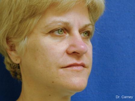 Virginia Beach Facelift 1346 - Before Image 2