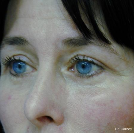 Virginia Beach Eyelid Lift 1139 - After Image 3