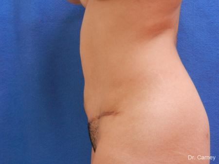 Abdominoplasty: Patient 2 - After Image 5