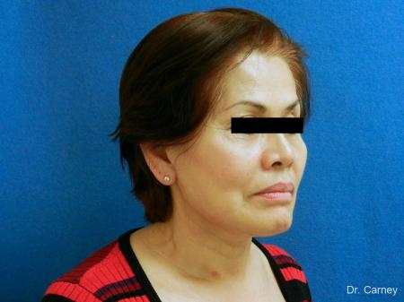 Virginia Beach Neck Lift 1268 - After Image 2