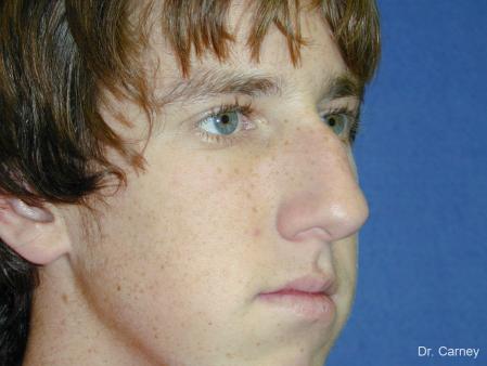 Virginia Beach Rhinoplasty 1219 - Before Image 3